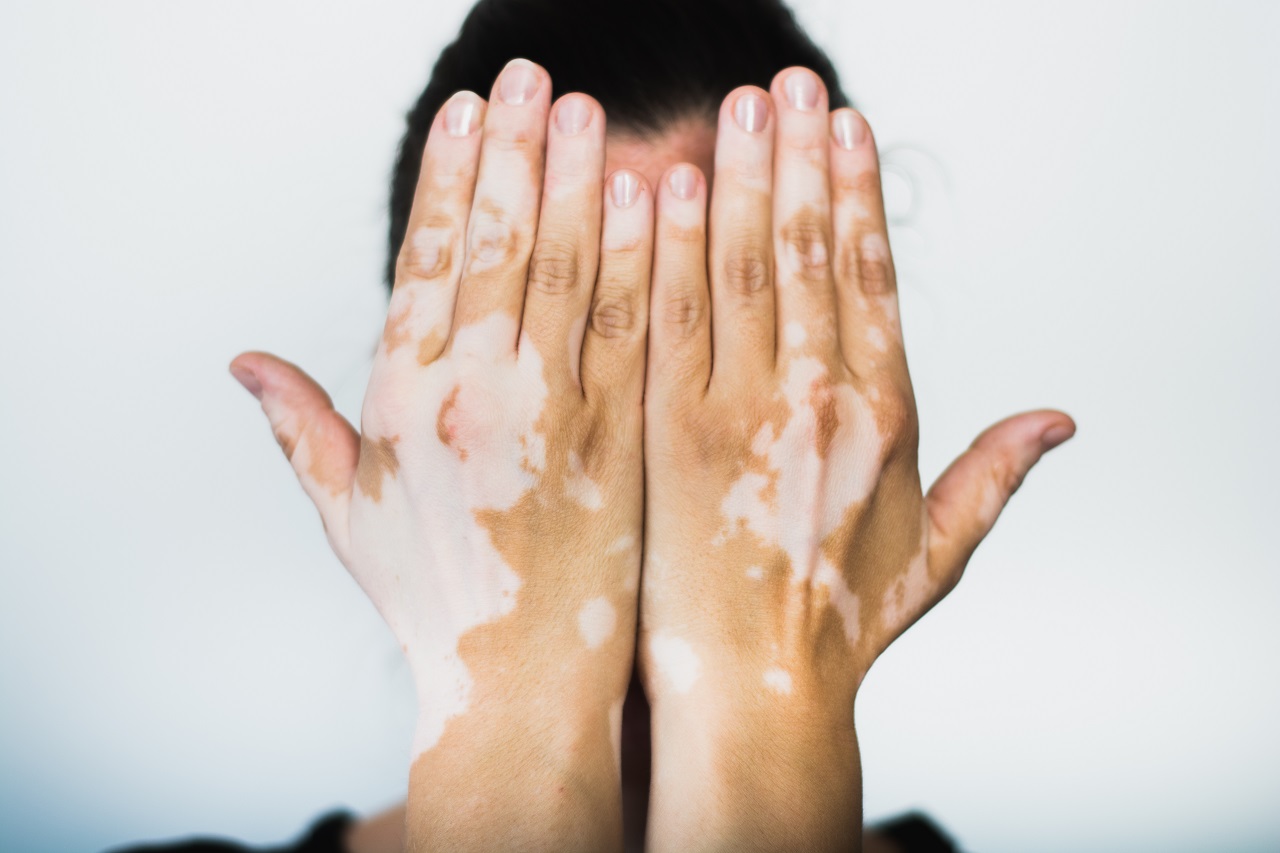 Vitiligo Treatment