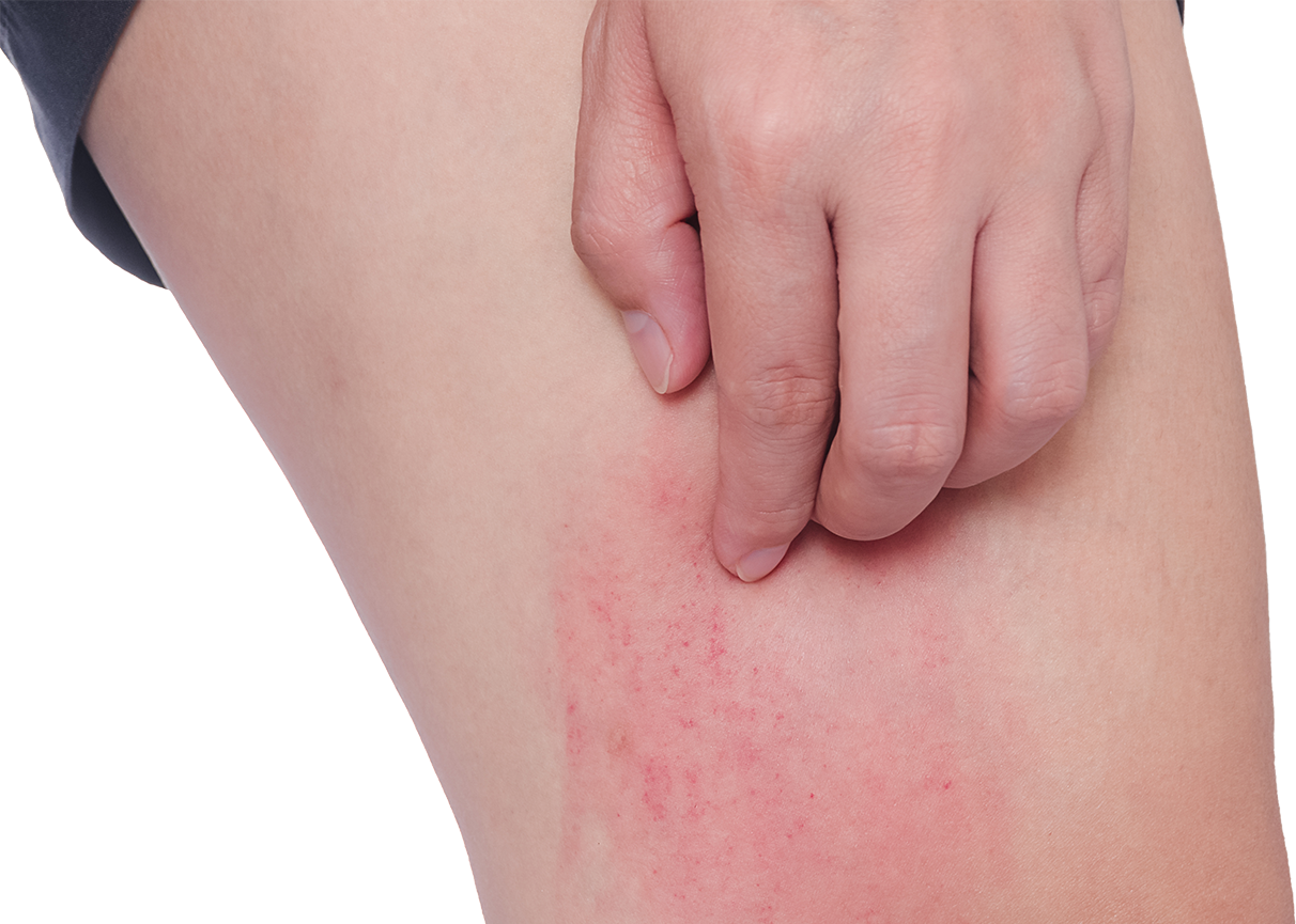 Skin Allergies Treatment