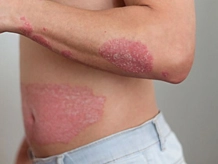 Psoriasis Treatment
